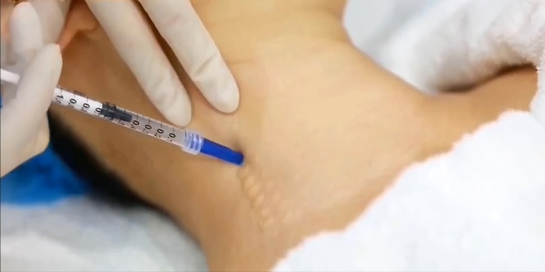 Multi Injector Needle