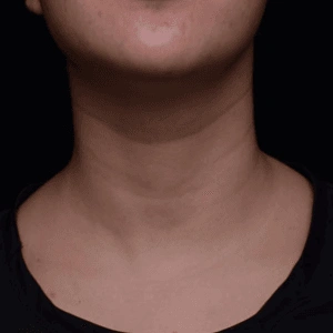 Neck wrinkles